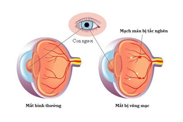 Benh tieu duong va nhung bien chung nguy hiem hinh anh 2